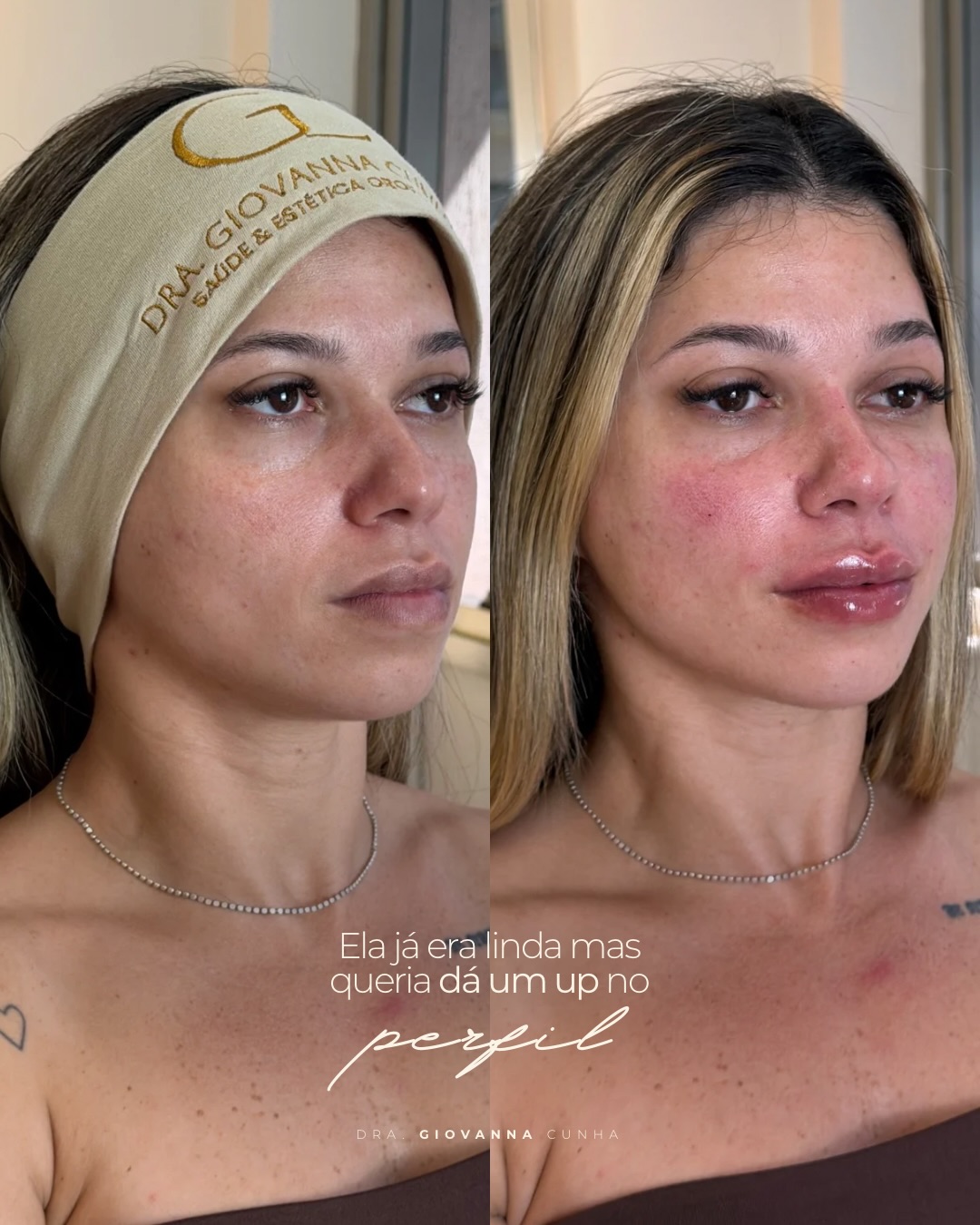 Comparação de perfil facial antes e após a harmonização publicada pela Dra. Giovanna