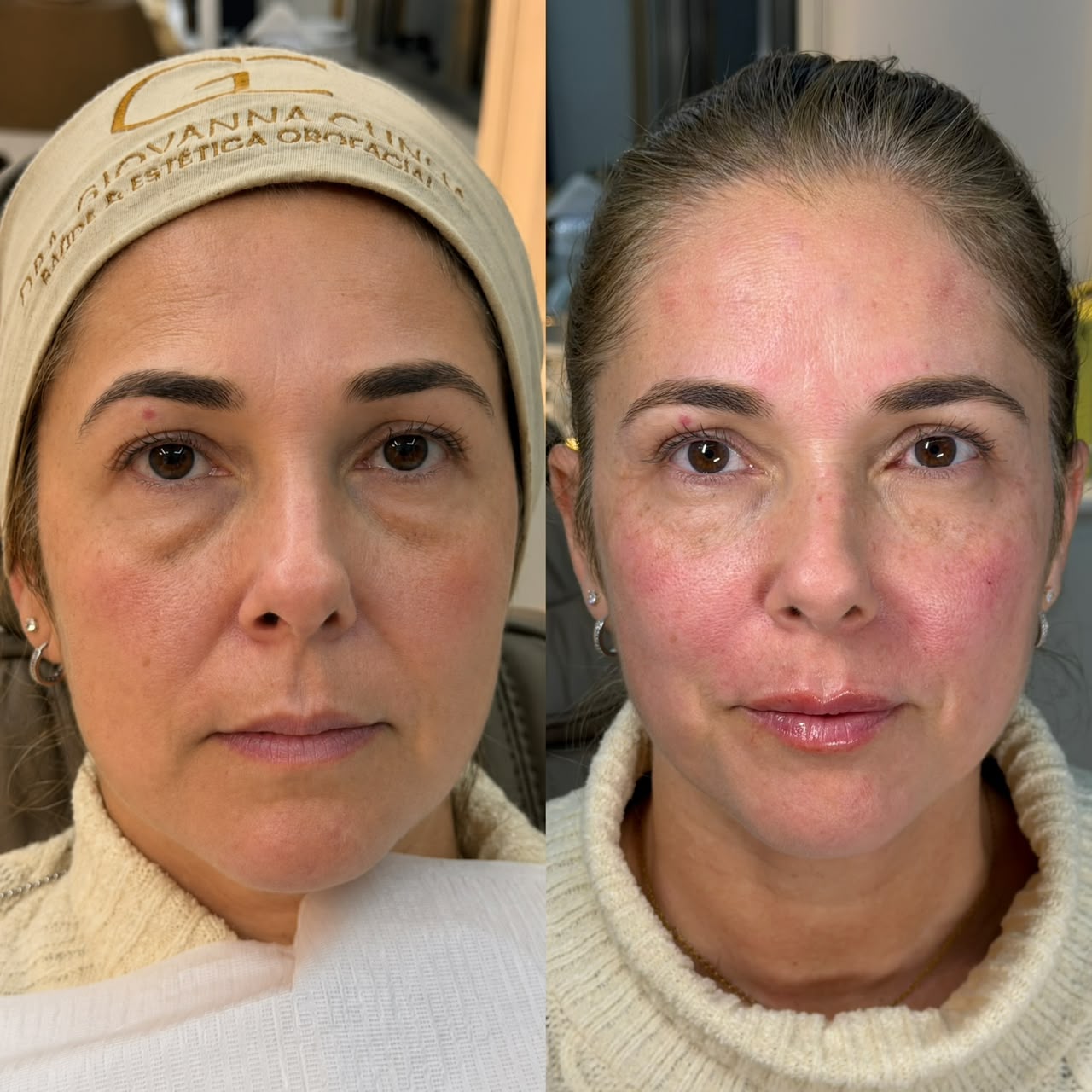 Comparação frontal da paciente antes e após o tratamento de rejuvenescimento facial