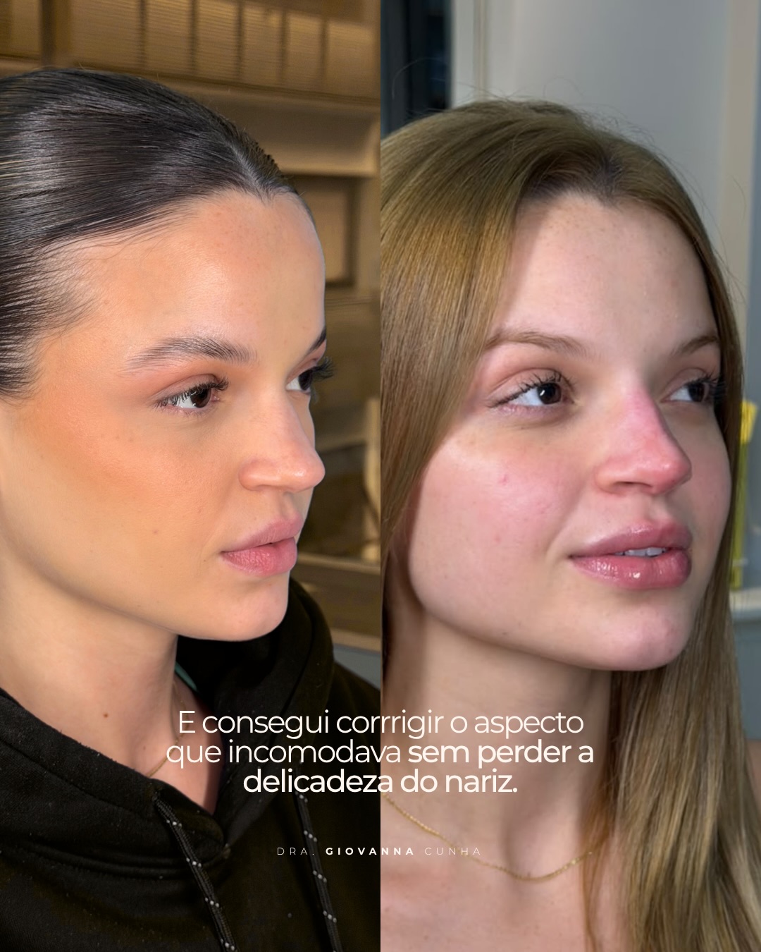 Comparação do nariz antes e após o acompanhamento de rinomodelação publicado pela Dra. Giovanna