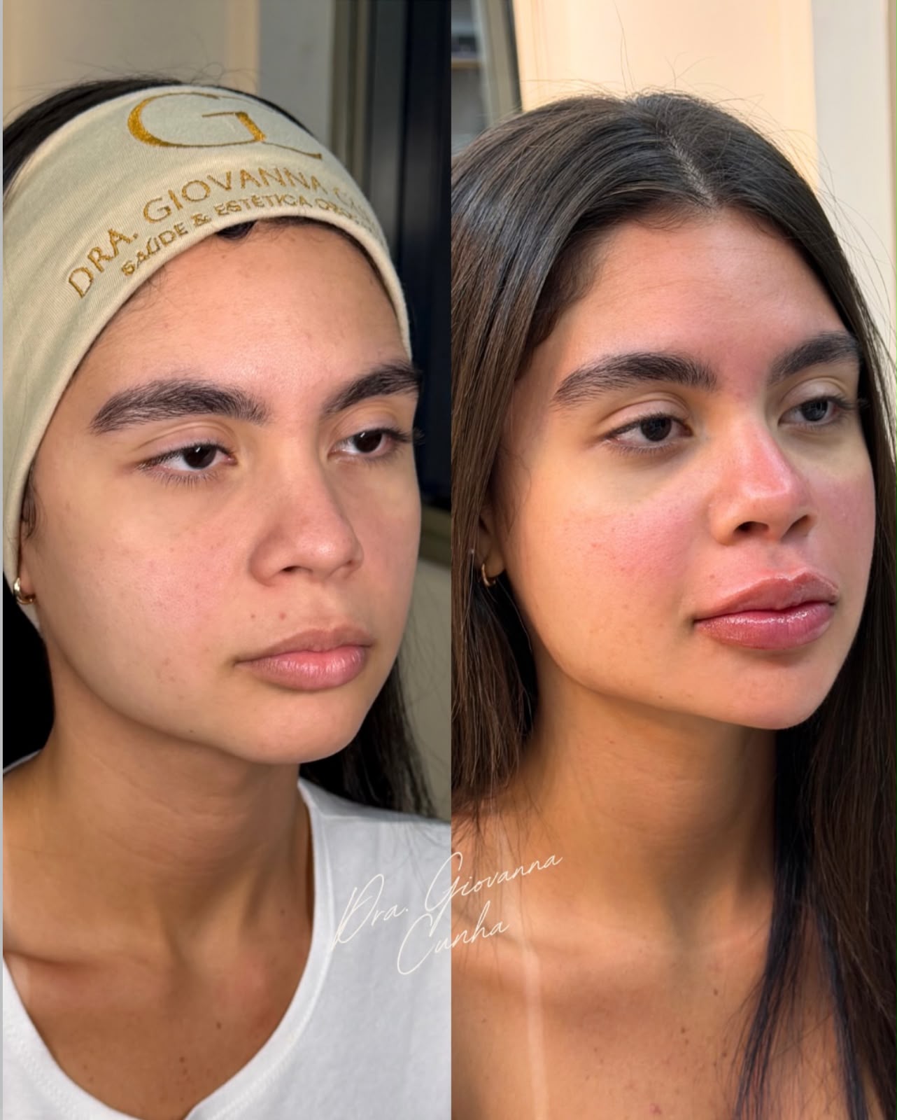 Comparação antes e depois de harmonização facial