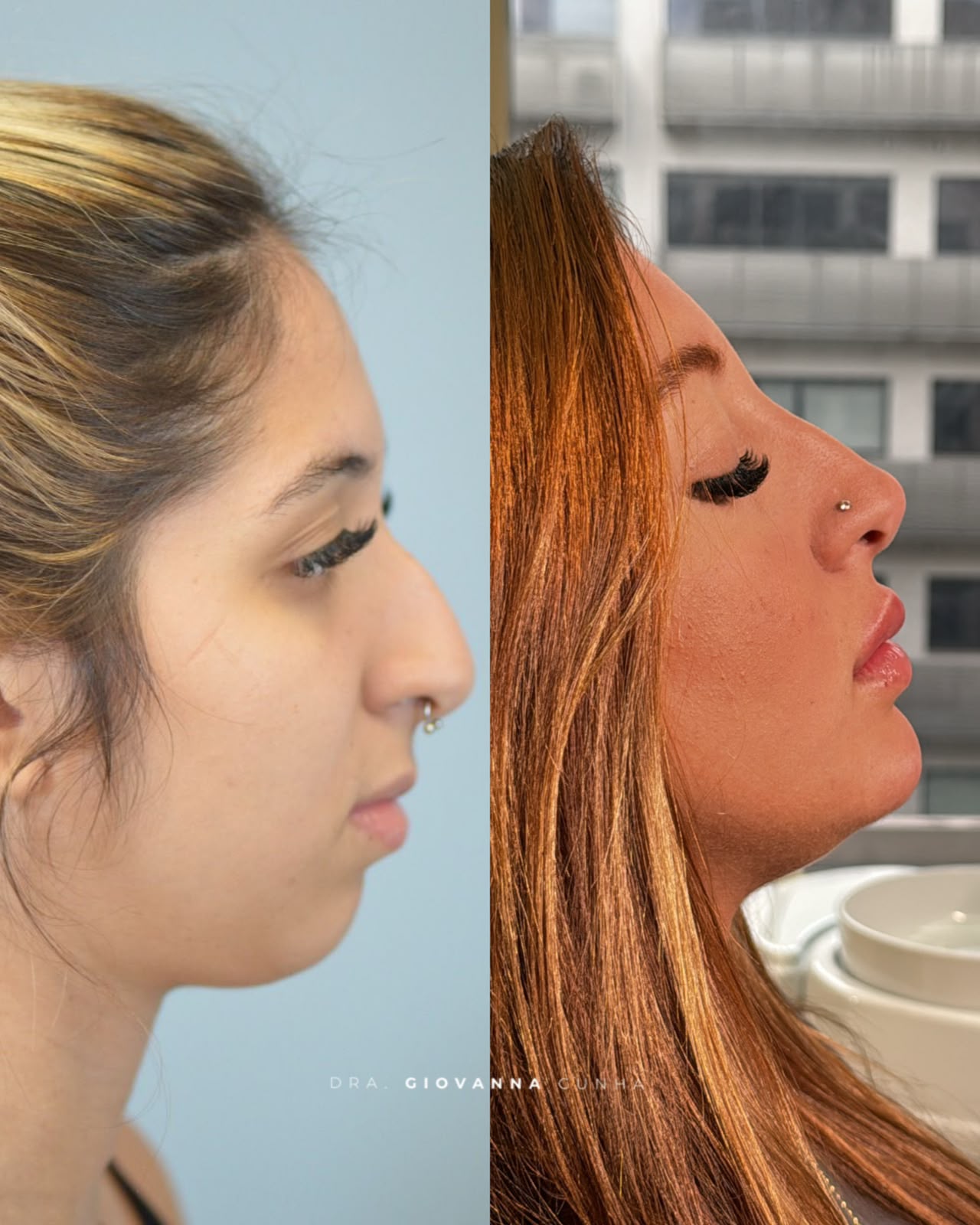 Comparação lateral de perfil fornecida para Nariz dos Sonhos